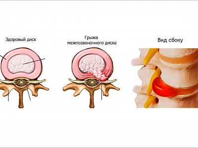 Грыжа межпозвонковых дисков: синдром «неудачной операции» 